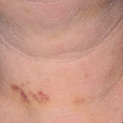 INhance Post-Injection Serum with TriHex Technology®