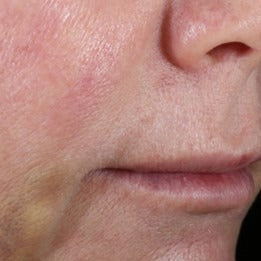 INhance Post-Injection Serum with TriHex Technology®