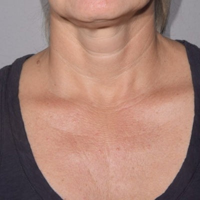 Restorative Neck Complex with TriHex Technology®