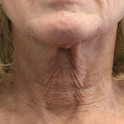 Restorative Neck Complex with TriHex Technology®