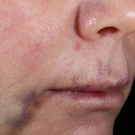 INhance Post-Injection Serum with TriHex Technology®