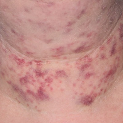 INhance Post-Injection Serum with TriHex Technology®