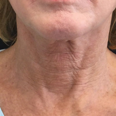 Restorative Neck Complex with TriHex Technology®